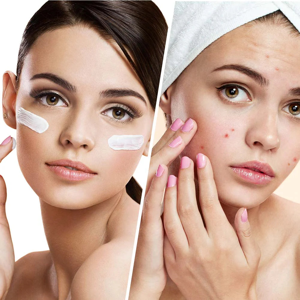 Clear Balance – Moisturizing face cream against pimples and imperfections with niacinamide 50 ml - Nutra Best Europe